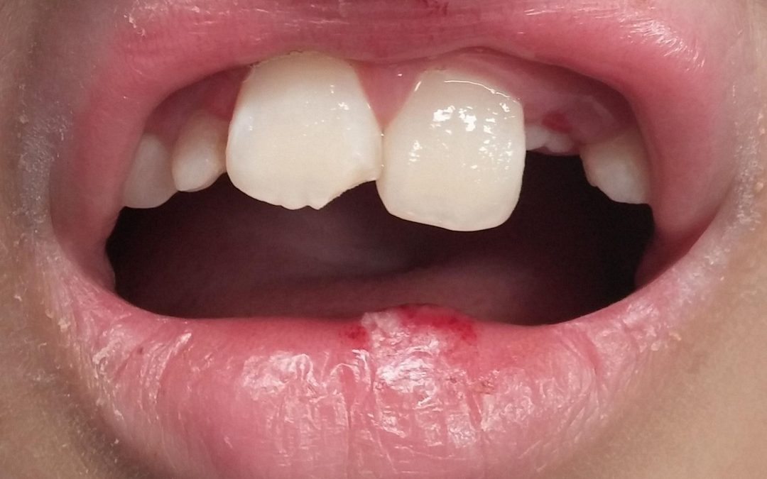 What to do with dental trauma?