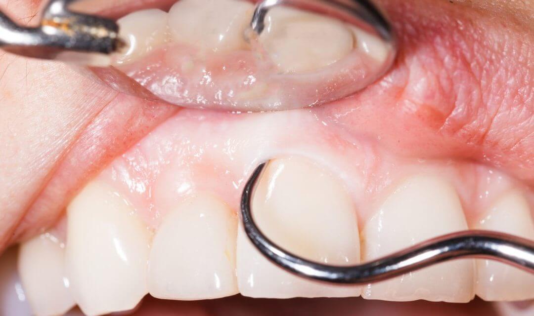Warning Signs of Gum Disease